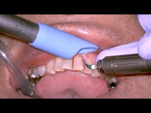 Subgingival calculus removal with Er：YAG laser
