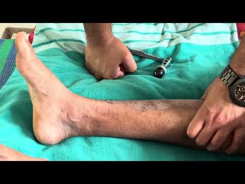 Gordon Sign Explained | Calf Squeeze UMN Reflex