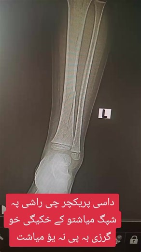 Understanding Small Tibia Fractures and Recovery Timeline