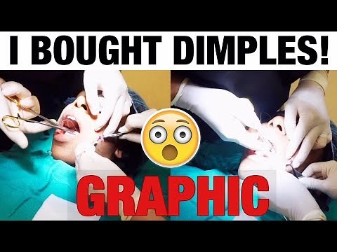 FACIAL COSMETIC SURGERY VLOG! HOW TO GET DIMPLES│ DIMPLEPLASTY PROCEDURE EXPERIENCE
