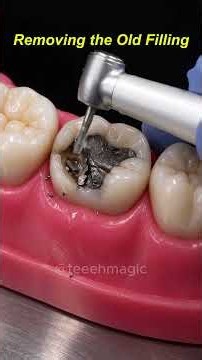 Old Filling to Natural-Looking Tooth | Satisfying Dental Restoration #dentist