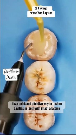 STAMP Technique Composite Anatomy Class I cavities