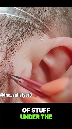 This GIANT ingrown hair looks just like a worm!🪱 (credit: @the_satisfyer0 on TT)