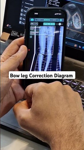 Bow leg correction diagram #bowlegs #bowlegsurgery