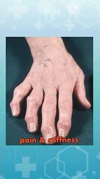 Hand Pain — Is it Osteoarthritis or Rheumatoid Arthritis?