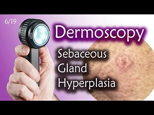 Sebaceous Gland Hyperplasia or BCC?