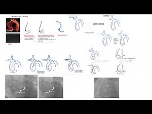Left coronary engagement (radial focus): detailed steps, diagrams, tips, and case videos-Elias Hanna