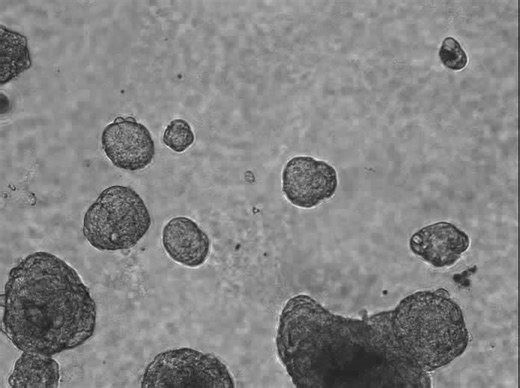 'Plasticity' in prostate cancer cells. What you're watching here is research work done by Australian Prostate Cancer Research Centre Queensland Group Leader Dr Nataly Stylianou. The research explore epithelial-mysenchymal plasticity in prostate cancer cells. The work has been published in PubMed Central's Nature Portfolio. https://pmc.ncbi.nlm.nih.gov/articles/PMC6514858/ Unfortunately the only thing holding this research back at the moment is funding. If you'd like to help us further this work 