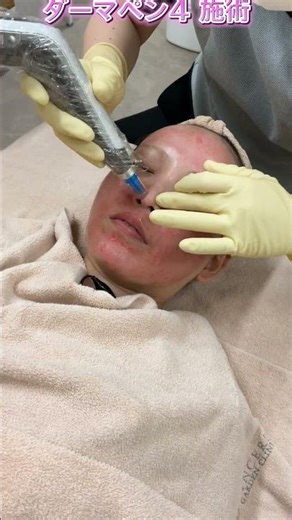[Dermapen 4 Treatment in Progress!!] Improvement of acne and acne scars, pore treatment