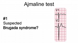 #brugadasyndrome #brugadasyndrome #epcinre #epeeps | Peter Blahút | 11 comments
