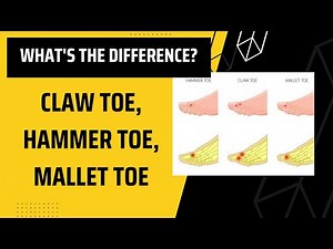 Do you know the difference? Claw toe, mallet toe, & hammer toe!