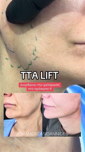 #beforeafter #πλαστικοσχειρουργοσ #plasticsurgeon