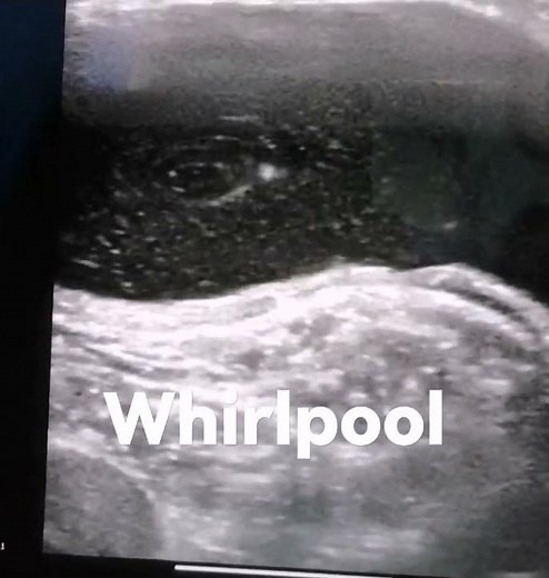 baker's cyst aspiration