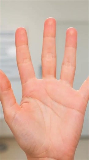 Trigger Finger Treatment Without Surgery