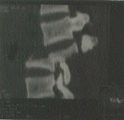 Spinal Fractures »  Lillian S. Wells Department of Neurosurgery at the University of Florida » College of Medicine » University of Florida