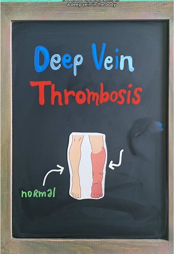 Understanding Deep Vein Thrombosis: Causes and Risks