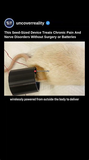 This Seed-Sized Technology Treats Chronic Pain & Nerve Disorders Without Surgery / Batteries #shorts