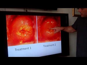 Dr LeRoy HPV Treatment