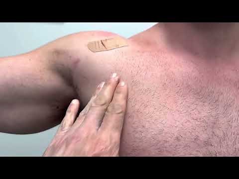 Can OLD Pec Major Tears be Repaired? Here’s a 15yo tear Reconstructed with #PecFlexFix