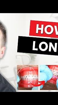 How long do braces take?