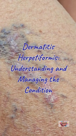 🩺 Dermatitis Herpetiformis: What You Need to Know | UrsTruly Prasanth