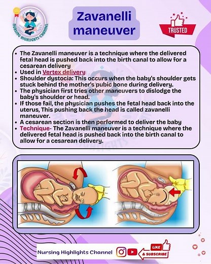 👶🏻 Zavanelli maneuver #norcet #aiims #nursing #gnm #obs #labour #msn #deliveryboy #rrb #baby #kgmu