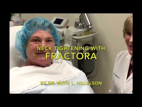 Fractora treatment of the neck by Dr. Ruth Hillelson