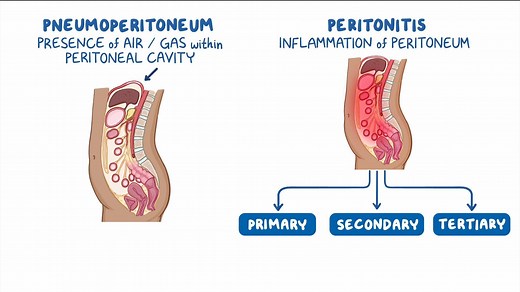 Video: Approach to pneumoperitoneum and peritonitis (perforated viscus): Clinical sciences - Video Explanation! | Osmosis | Osmosis