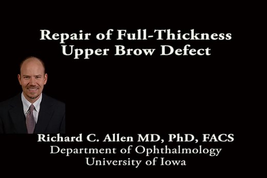 Repair of full-thickness upper eyelid defect