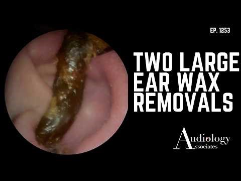 Two Big Ear Wax Plugs – Including a Deep Recess Removal - EP1253