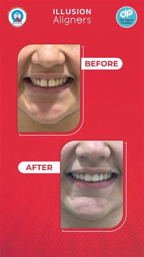 Midline diastema (gap between the upper front teeth) is a common dental concern that can affect confidence. But the good news is — it’s completely treatable! Causes can include oral habits, spacing, or jaw-tooth size mismatch Treatment Modality: Illusion Aligners Result: A beautifully aligned, confident smile by Dr. Anu Mittal Just like this case 👉 notice the transformation of the smile when the gap is corrected. Contact us today for more information! #MidlineDiastema #GapTeethTreatment #Confid