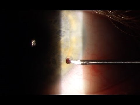 Corneal Foreign Body Removal