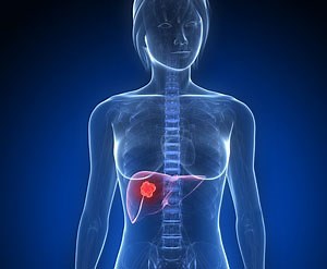 Tumeur du foie : symptômes, traitement, définition