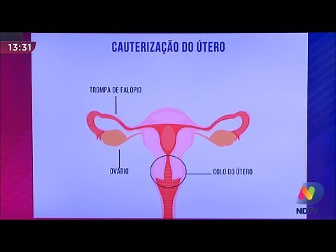 Ectopia Cervical (ferida no colo do útero) : causas , sintomas, tramento - Dr. Belarmino