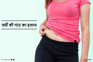 चर्बी की गांठ का इलाज और घरेलू उपचार - Charbi Ki Ganth Ka Ilaj Aur Gharelu Upchar in Hindi | Lipoma Treatment