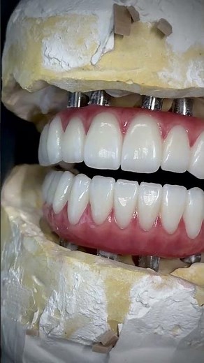 Hybrid All-on-X Denture that we just completed in my lab for Dr. Samantha Chou n Illinois