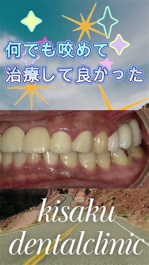 インプラント ビフォーアフター 部分入れ歯にしたくないのでインプラントにした 【Before & After】 #インプラント治療＃きさくデンタル＃歯医者