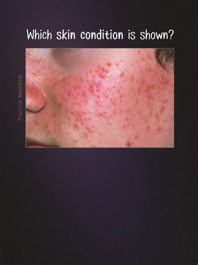 [OSCE: Picture Test] Which skin lesion is shown and what is the treatment? #OSCE #Dermatology #SkinRash #SkinInfections #SpotDiagnosis #Diagnosis #Acne #AcneTreatment #Acnecauses