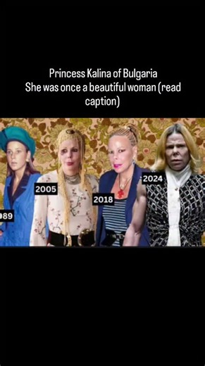 @historyfacts_here | but this changed over time Apparently she had a botched dental procedure 26 years ago resulting in major infection which destroyed her... | Instagram