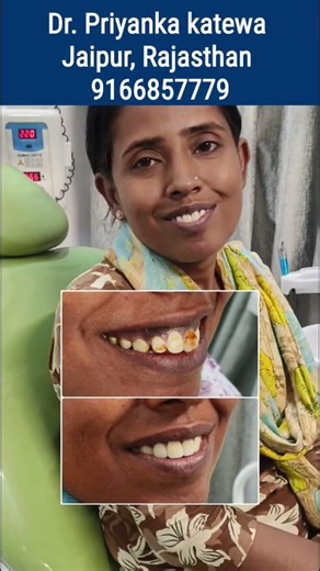 smile transformation//dental fluorosis treatment in 2 days #jaipurdentist #smiletransformation