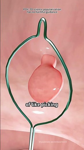 Uterine Polyps Removal Surgery (3D Animation)