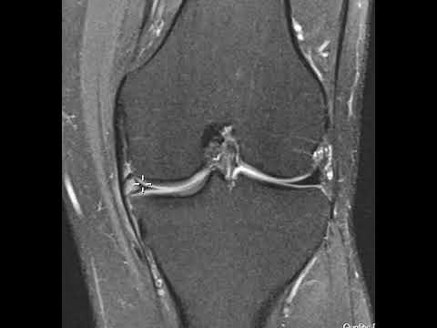 Meniscal cyst