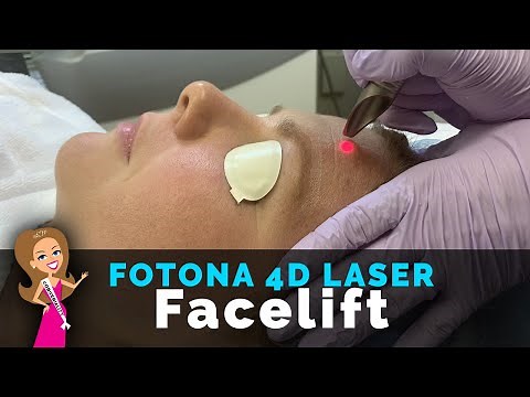 What Does Fotona 4D Laser Feels Like? | Laser FACELIFT | Laser Skin Tightening | Build Collagen