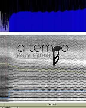 What is Diplophonia in the Voice?