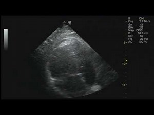 CARDIAC - McConnell sign (acute submassive pulmonary embolism)