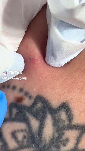 Wait for it #blackhead #extractions #pimple #pimplepopping #squeezing #spotsqueezing #ingrownhair #addiction