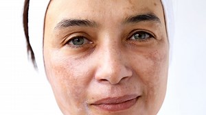 Expert Breaks Down How To Spot Melasma On Your Skin
