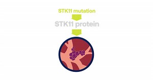 STK11 and Lung Cancer