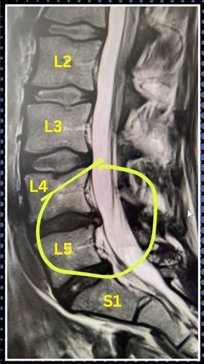 Foot Drop Recovery Starts When You Trust the Process #footdrop