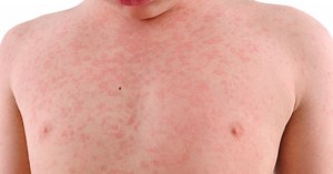 Identifying meningitis and nine other rashes on your child